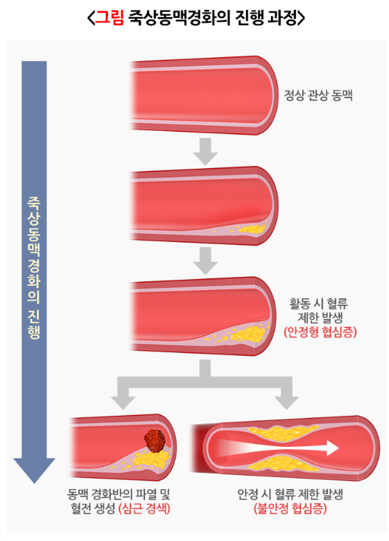 협심증 죽상동맥경화의 진행 과정